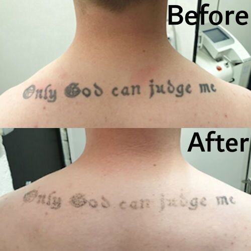 imge of lettering tattoo removal, laser tattoo removal